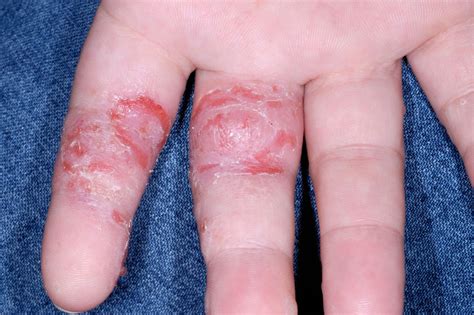 Pompholyx (dyshidrotic eczema) - NHS