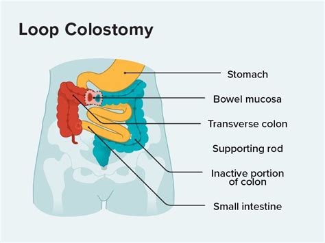 Loop Colostomy: What You Should Know