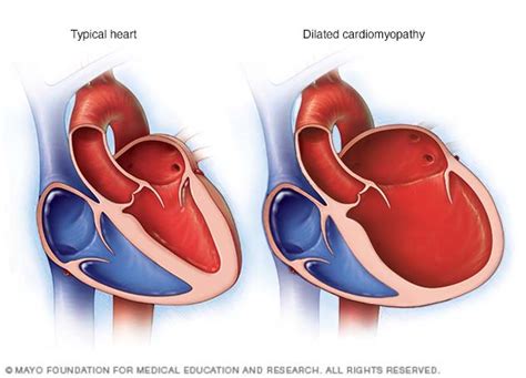 Dilated cardiomyopathy - Mayo Clinic