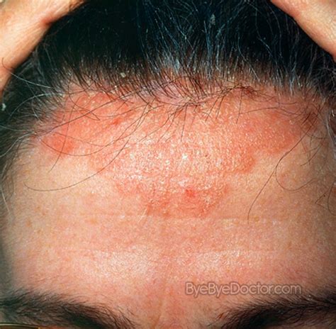 Scalp psoriasis - Pictures, Treatment, Symptoms, Home remedies, Cure