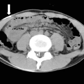 (PDF) Complications Associated with Surgical Treatment of Hydrocephalus