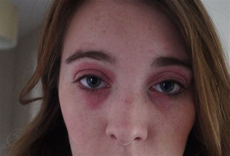 Allergic Reaction To Makeup Under Eyes - Mugeek Vidalondon