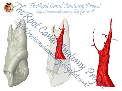 The Root Canal Anatomy Project: Two-Rooted Maxillary Central Incisor