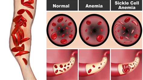 Doctors Explain the Causes and Signs of Sickle Cell Anemia