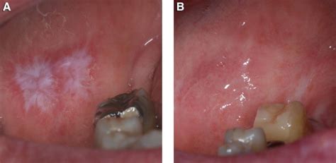 Clinical and histologic healing of lichenoid oral lesions following ...