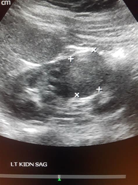 Renal cell carcinoma | Renal cell carcinoma, Renal cell, Ultrasound