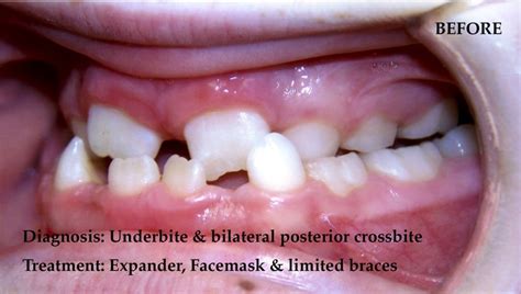 Diagnosis: Underbite & Bilateral Posterior Crossbite | Crossbite ...