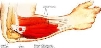 Lateral Epicondylitis | Musculoskeletal Treatment