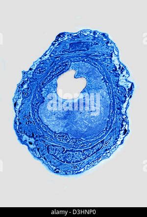 ATHEROMA, HISTOLOGY Stock Photo - Alamy