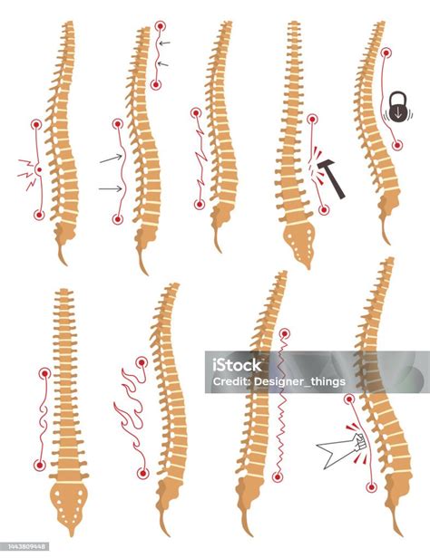 Spinal Deformity Types Symbols Of Spine Curvatures Or Unhealthy ...