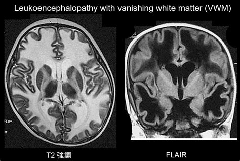 Diagnostic Imaging of White Matter Abnormalities | Congenital cerebral ...