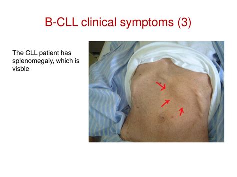 PPT - The Chronic Lymphocytic Leukemia (CLL) PowerPoint Presentation ...