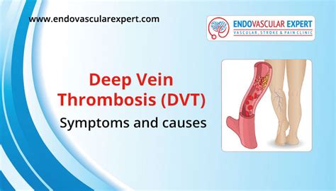 Deep Vein Thrombosis | Symptoms and Causes | EndovascularExpert