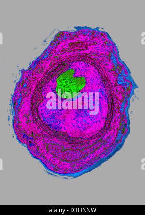 ATHEROMA, HISTOLOGY Stock Photo - Alamy