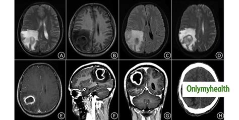 Cerebral Abscess: Symptoms, Causes, Diagnosis And Treatment Of Brain ...