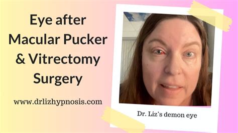 Eye after Macular Pucker and Vitrectomy Surgery with Dr Liz - YouTube