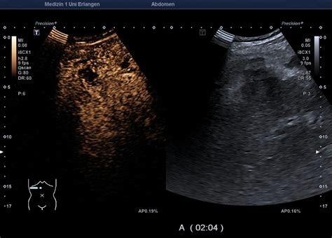 Gallbladder perforation – Atlas of Ultrasound