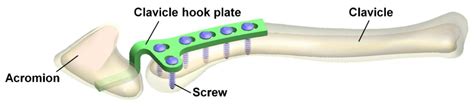 Applied Sciences | Free Full-Text | Biomechanical Analysis of Clavicle ...