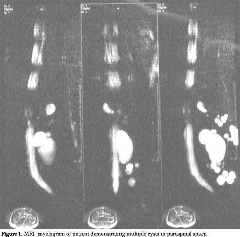 Figure 1 from An Unusual Case of Hydatid Cyst | Semantic Scholar