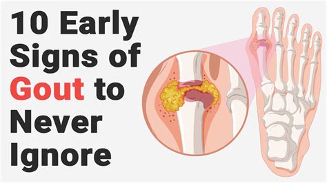 10 Early Signs of Gout to Never Ignore | Signs of gout, Gout remedies ...