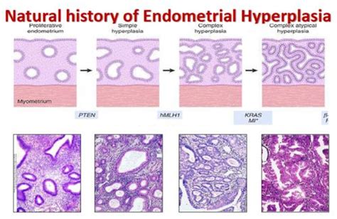 the stages of endometal hypplasia in different cells, including