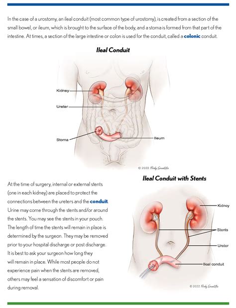 Ileal Conduit