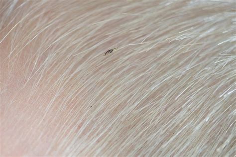 can lice survive in black hair - Greathearted Ejournal Photo Gallery