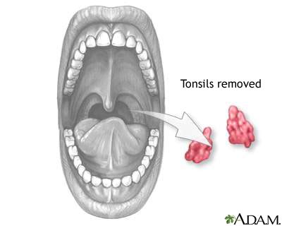 Tonsils Before And After