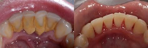 Debridement Dental