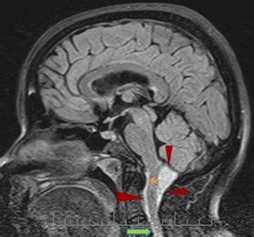 An Extremely Rare Case Report of Foramen Magnum Dermoid Cyst Presenting ...