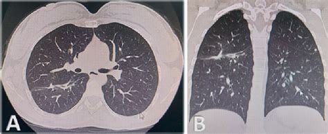 Figure 3 from Pulmonary abscess due to Streptococcus intermedius in ...