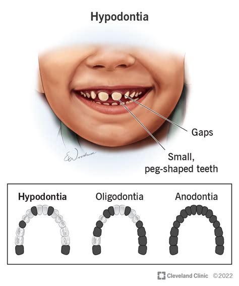 Hypodontia (Missing Teeth): Causes & Treatment