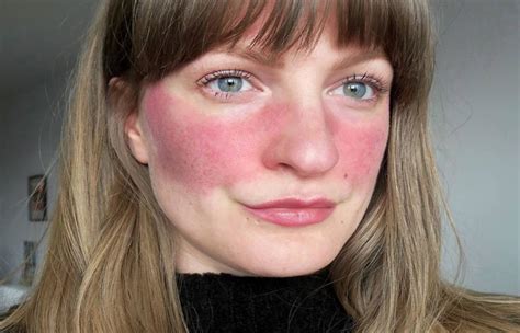 Rosacea Treatment - SCULPTDTLA.COM