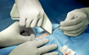 Recent Finding Reveals Over 50k Surgical Stapler Complications Were ...