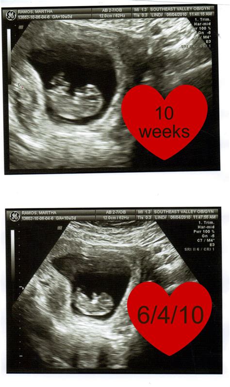 Baby Medrano: 10 week ultrasound