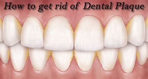 How To Get Rid Of Plaque On Teeth