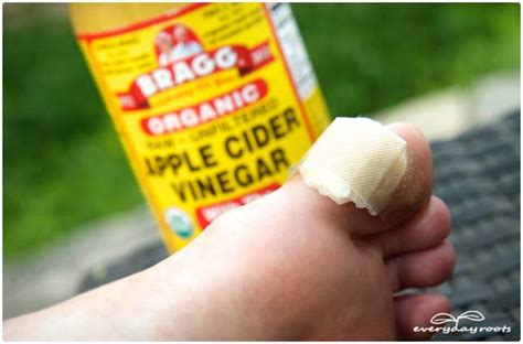 10 Common Remedies to Get Rid of Warts | Everyday Roots