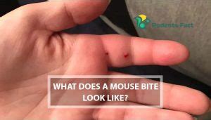 Mouse Bite Treatment | 4 Dangers, and Remedies of Mouse Biting