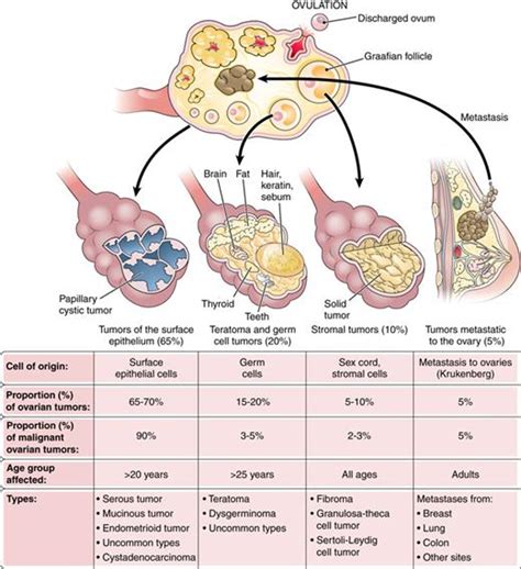 Ovarian Tumor (Benign) | Diseases & Conditions | 5MinuteConsult