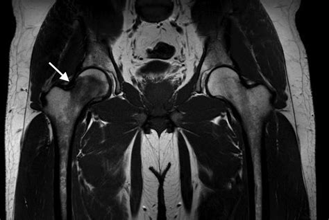 A Thirty-one-Year-Old Man with Acute Right Hip Pain - JBJS Image Quiz