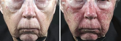 Topical Fluorouracil for Actinic Keratoses and Photoaging: A Clinical ...