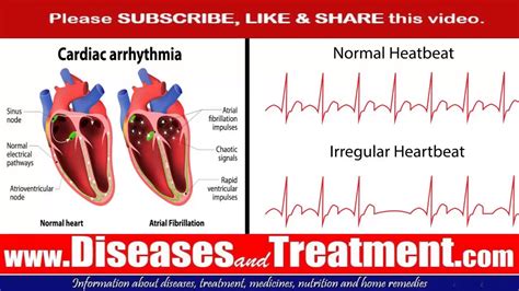 Arrhythmia (Abnormal heart rhythms) : : Causes, Symptoms, Diagnosis ...