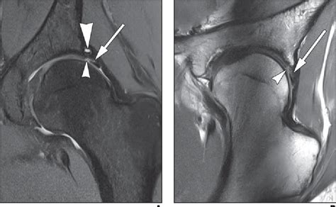 Figure 3—22 from MRI of Labral and Chondral Lesions of the Hip ...