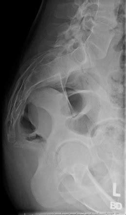 Sacrum Anatomy Xray