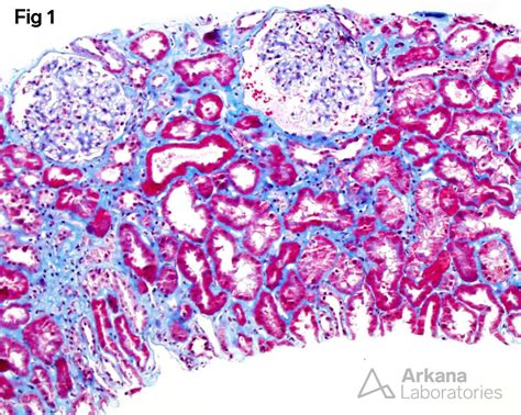 Light Chain Deposition Disease | Teaching Points | Arkana Laboratories