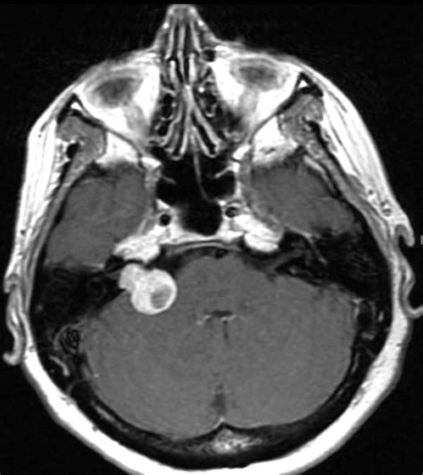 Vestibular Schwannoma. - Neuro MR Case Studies - CTisus CT Scanning