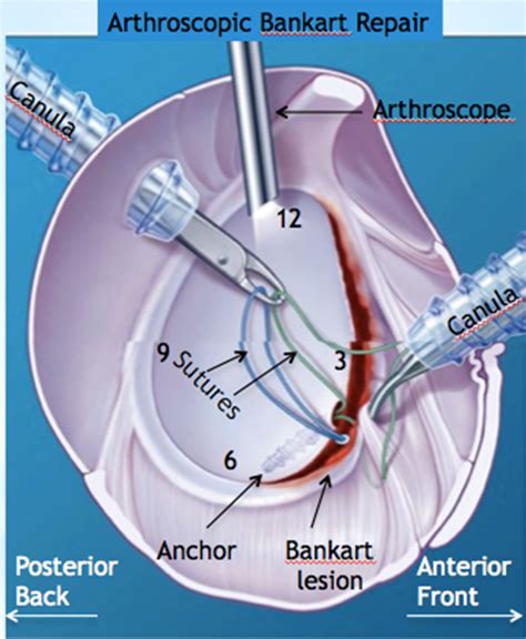 Treatment of Recurrent Anterior Shoulder Instability | Boston Shoulder ...