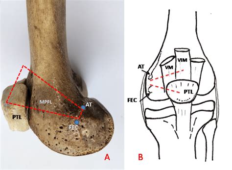 Cadaveric Study to Define the Anatomy of the Medial Patellofemoral ...