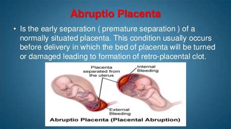 Antepartum Hemorrhage