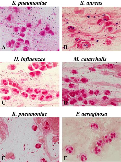 Bacterial morphotypes in sputum Gram stain (×100, oil immersion field ...